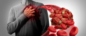 Blood clot prevention