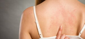 Stevens Johnson Syndrome rash